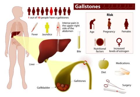 Symptoms of Gallstones and Gallbladder Disease