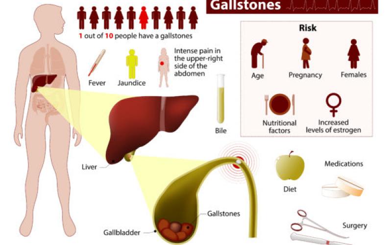 Symptoms of Gallstones and Gallbladder Disease